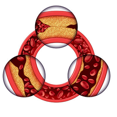 Arteriosklerose Herz-Kreislauf-System